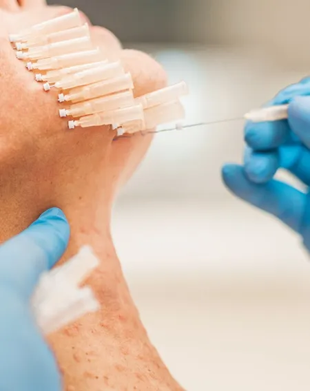 Sunrise Aesthetic Treatment - PDO Mono Thread Collagen Induction